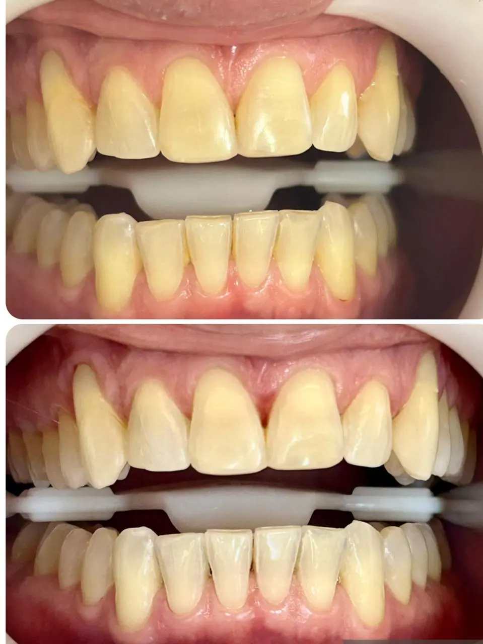 Clareamento dental - Clivive Odontologia