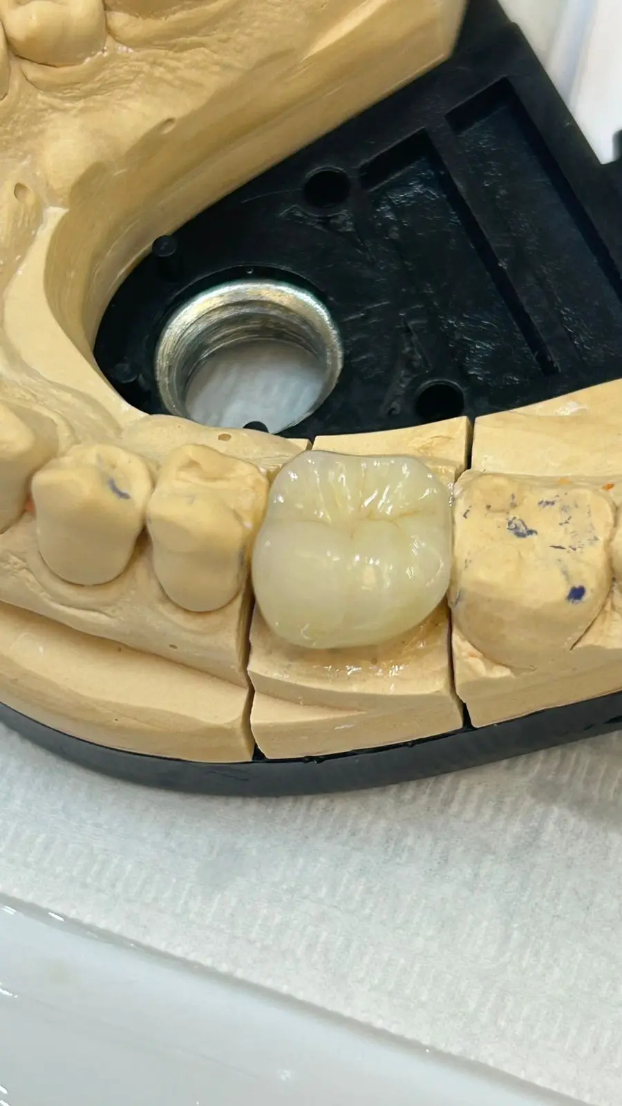 Coroas e pontes - Clivive Odontologia