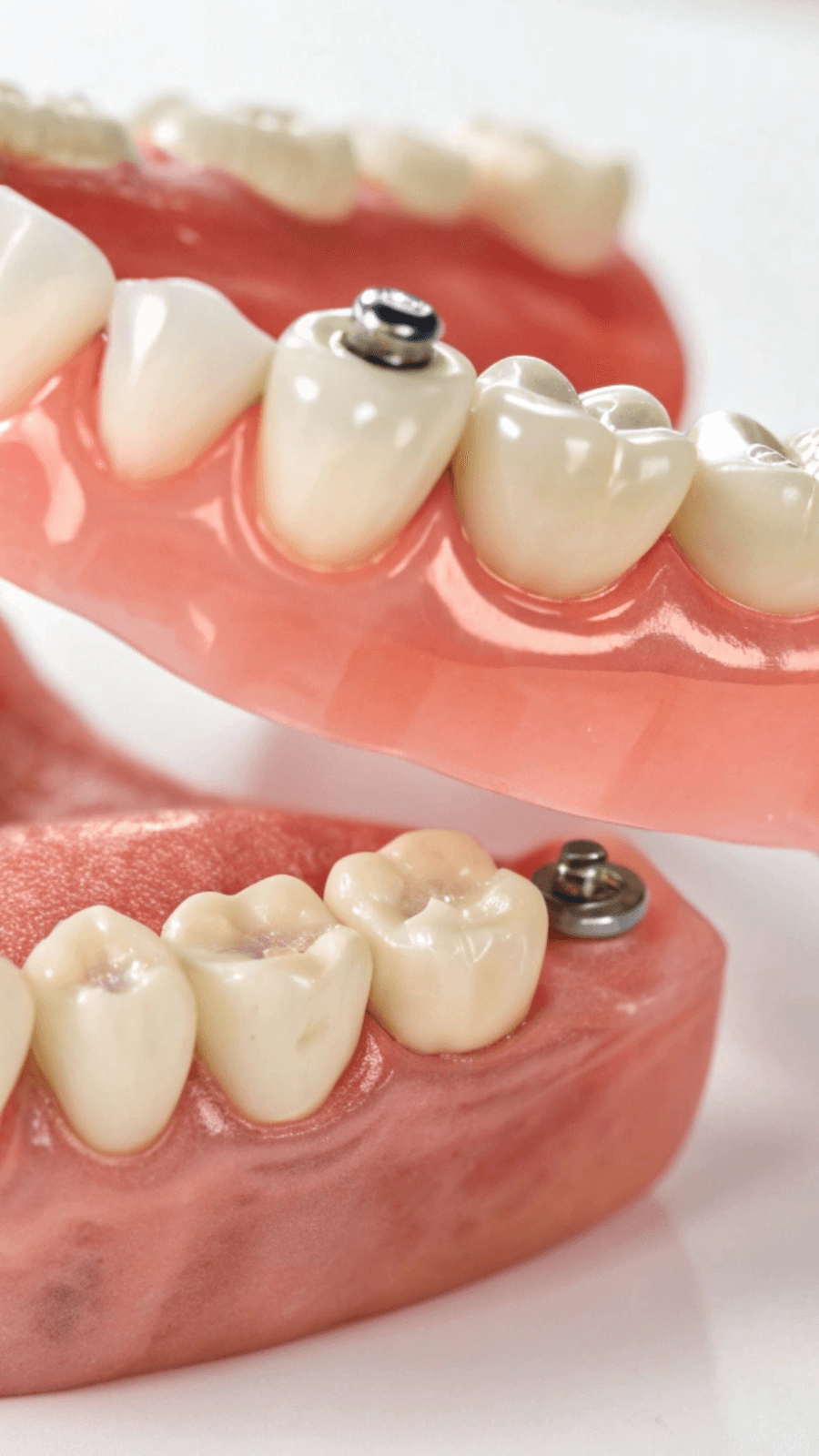 Implantes dentários - Clivive Odontologia