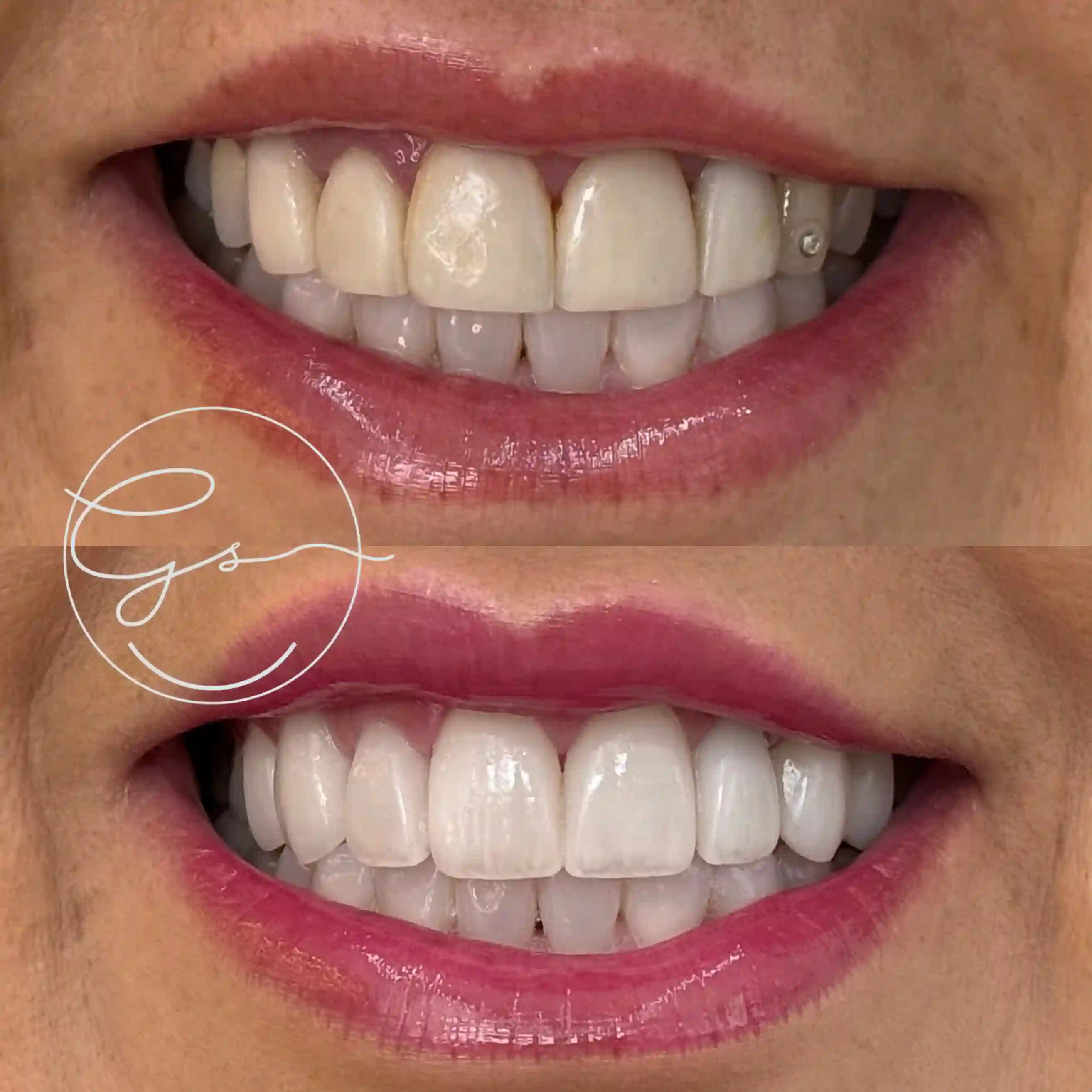 Lentes de porcelana - Clivive Odontologia