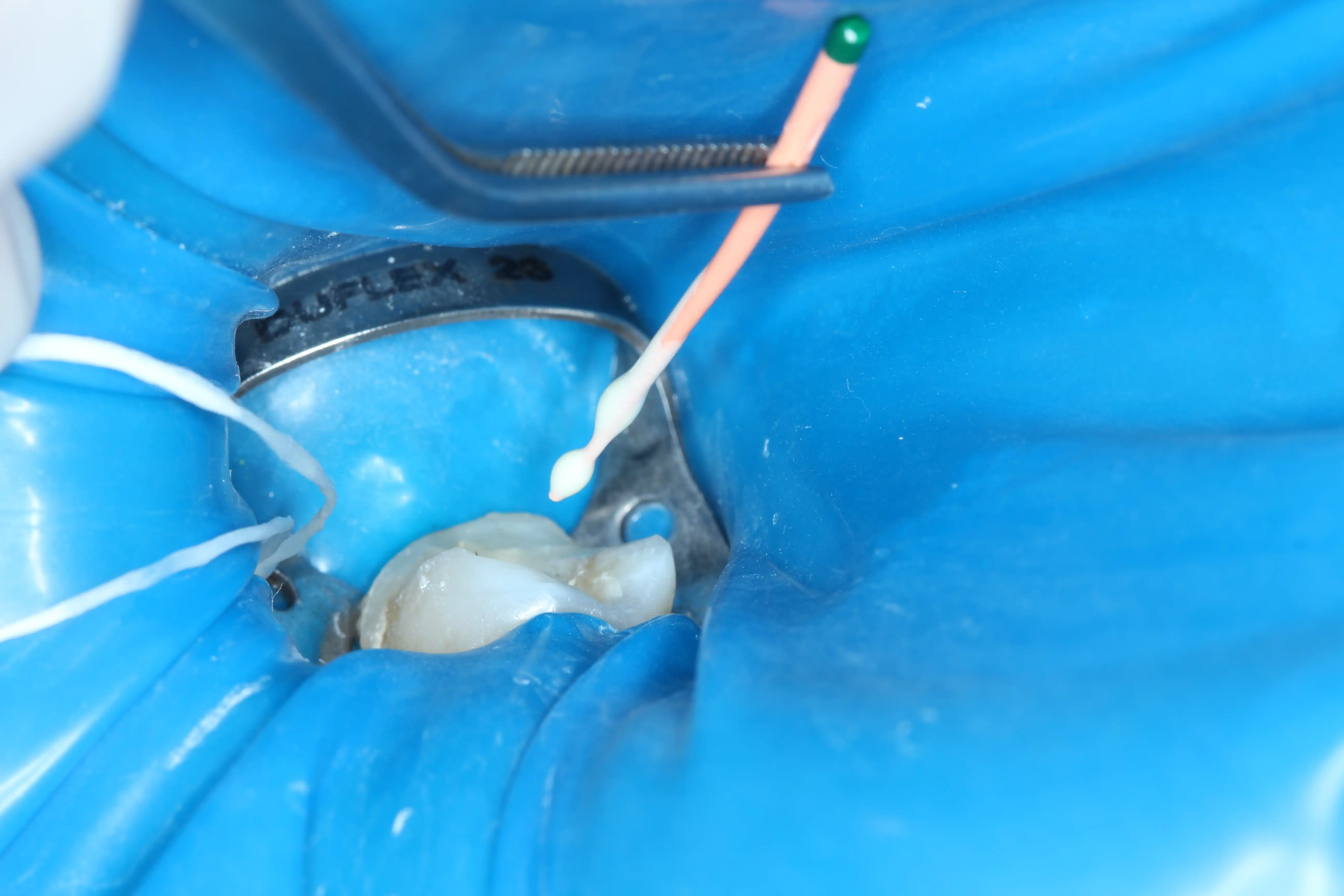 Tratamento de canal (Endodontia) - Clivive Odontologia